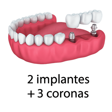 ¿Qué es un puente sobre implantes?