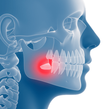 ¿Qué es una extracción dental o exodoncia?