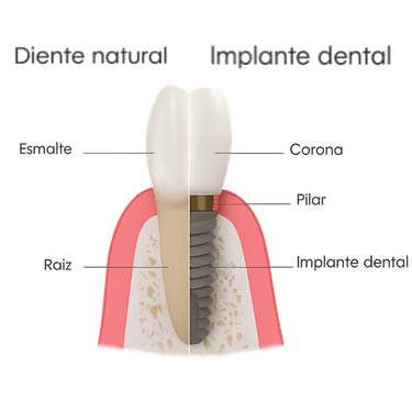¿Qué son los implantes dentales?