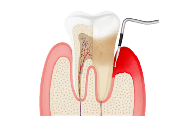 Raspado y alisado radicular