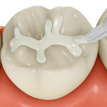 ¿Qué es el sellado dental?