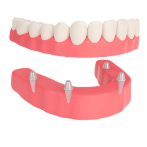 Dentadura removible con implantes dentales