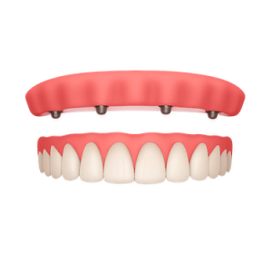 Sobredentadura sobre implantes