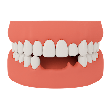 ¿Cuándo recurrimos a un puente sobre implantes?