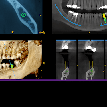 Valoración de implantes dentales