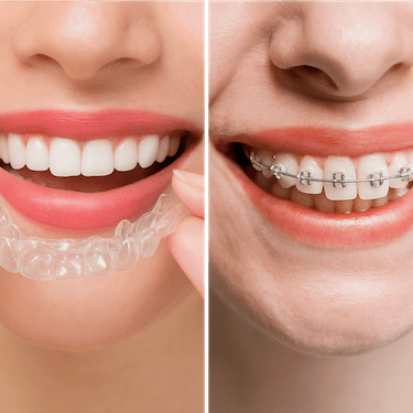 Colocación de ortodoncia