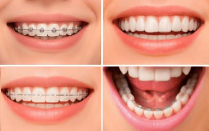 Tratamientos de ortodoncia