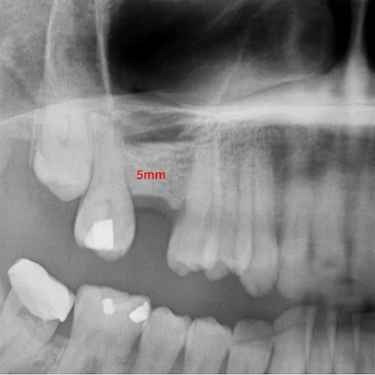 ¿Cuándo es necesario un injerto de hueso dental?