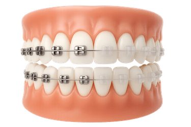 ¿Cuáles son los tipos de ortodoncia?