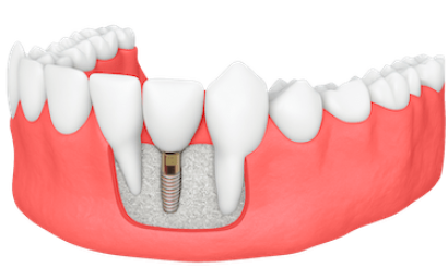 Falta de hueso para implantes dentales