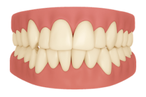Apiñamiento dental