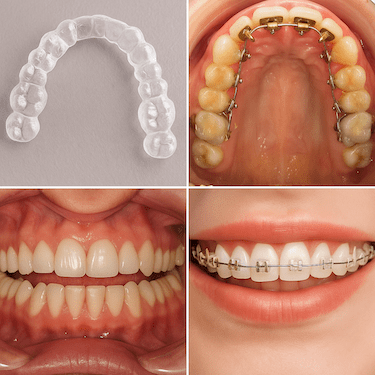 ¿Qué es una ortodoncia?