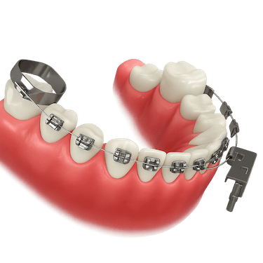 Retirada de la ortodoncia