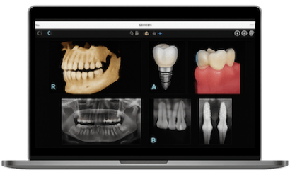 Falta de hueso que impide colocar implantes