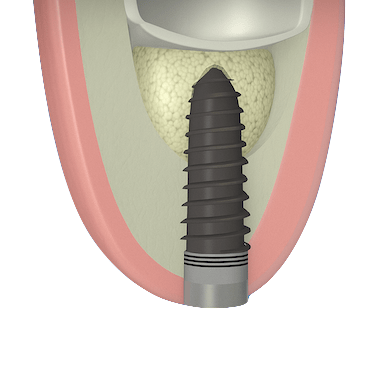 Colocación del implante dental