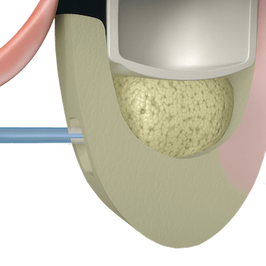 Colocación del material de injerto óseo