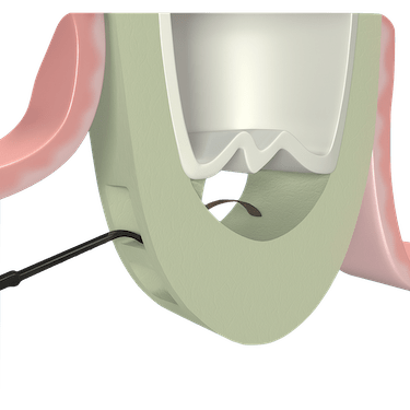 Elevación de la membrana sinusal