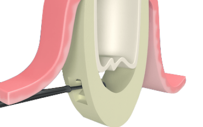 Elevación de seno maxilar para implantes