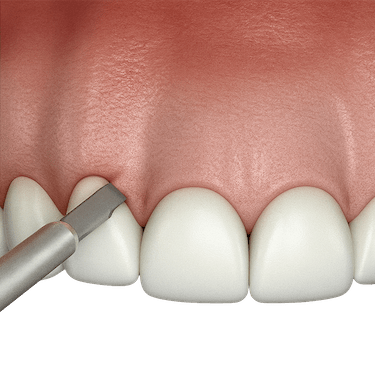Cómo se realiza el alargamiento coronario paso a paso