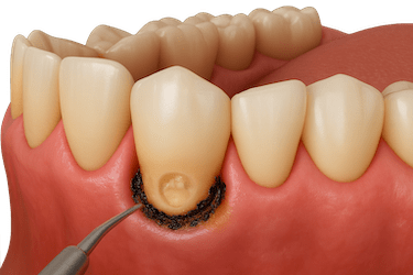 Caries subgingivales