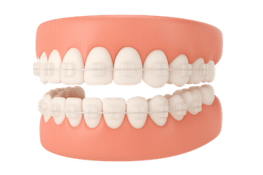 ¿Qué son los brackets estéticos?