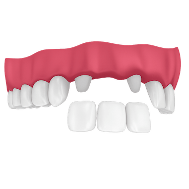 ¿Qué es un puente dental tradicional?