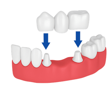 Puente dental tradicional
