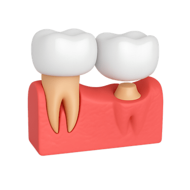 Puente dental voladizo o cantiléver