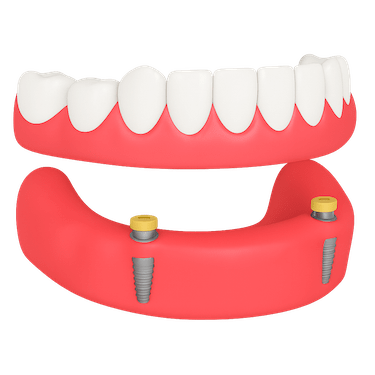 Sobredentadura con locator dental