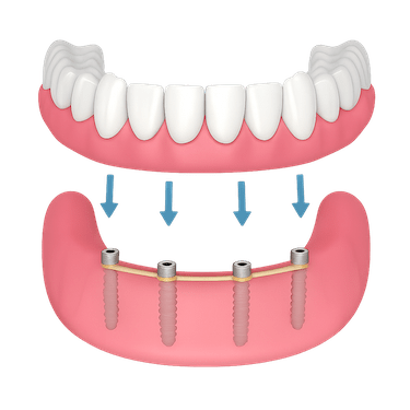 Colocación de la sobredentadura y adaptación