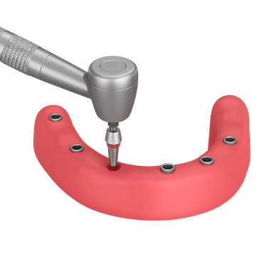 Colocación de implantes para prótesis híbrida
