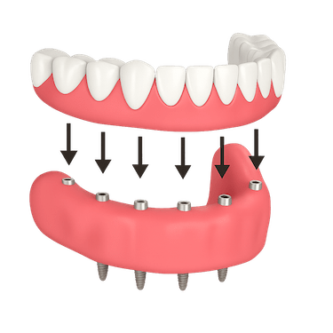Colocación y adaptación de la prótesis híbrida