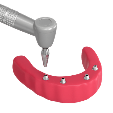 Cirugía de implantes para sobredentadura