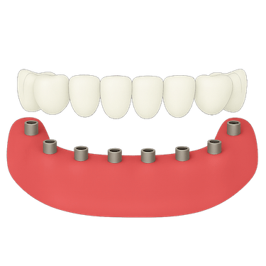 Prótesis dental fija con coronas