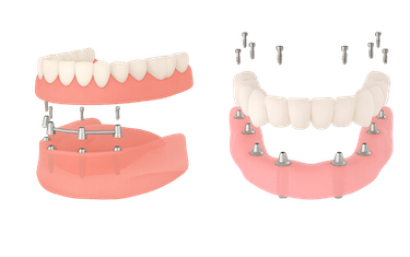 Prótesis dentales completas con implantes
