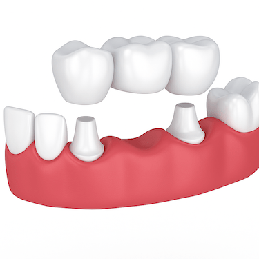 ¿Cómo realizamos un puente dental en nuestra clínica de Murcia?