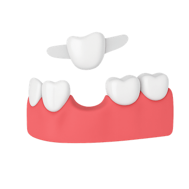 Puente dental Maryland