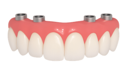 Prótesis removible con implantes