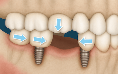 Cambios en la posición dental