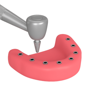 Colocación quirúrgica de los implantes
