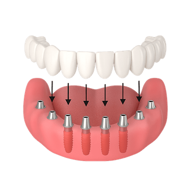 Fijación de la prótesis definitiva