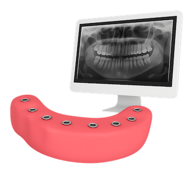 Estudio personalizado previo a la rehabilitación