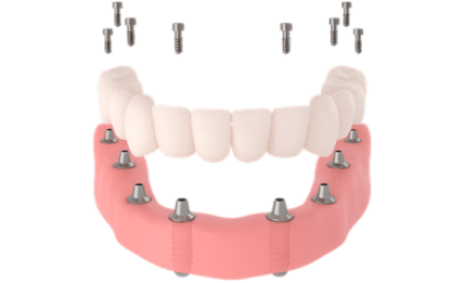 Una prótesis que actúa como dentadura postiza fija sobre implantes