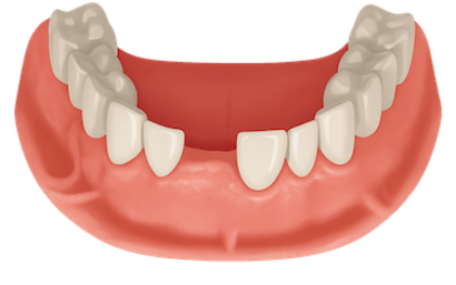 Sustituir un diente perdido con un implante 