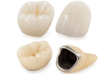 ¿Qué corona sobre implante dental elegir?