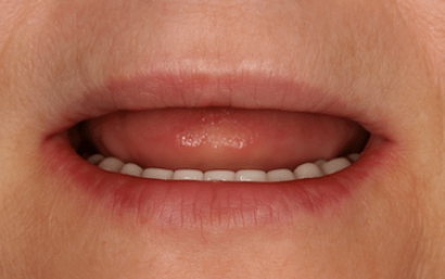 Una prótesis fija completa para recuperar todos tus dientes