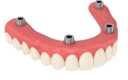 Prótesis removible con implantes en Murcia