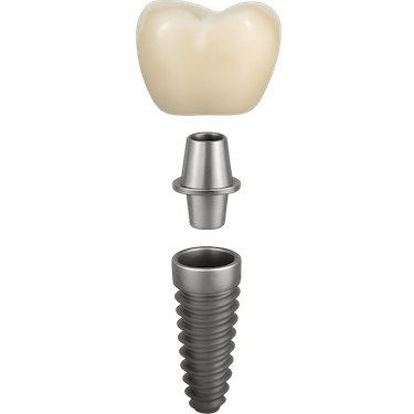 Corona sobre implante cementada