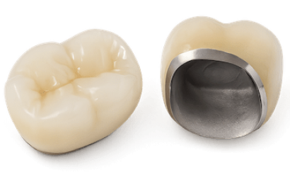 Coronas sobre implantes