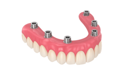 Prótesis dental hibrida en Murcia